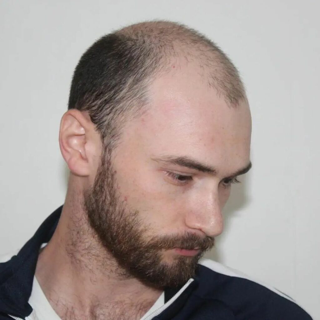 Male Pattern Baldness Real Me SMP